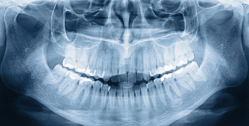 Miért fontos, hogy egy fogászati rendelőben tudjanak röntgenfelvételt is készíteni?