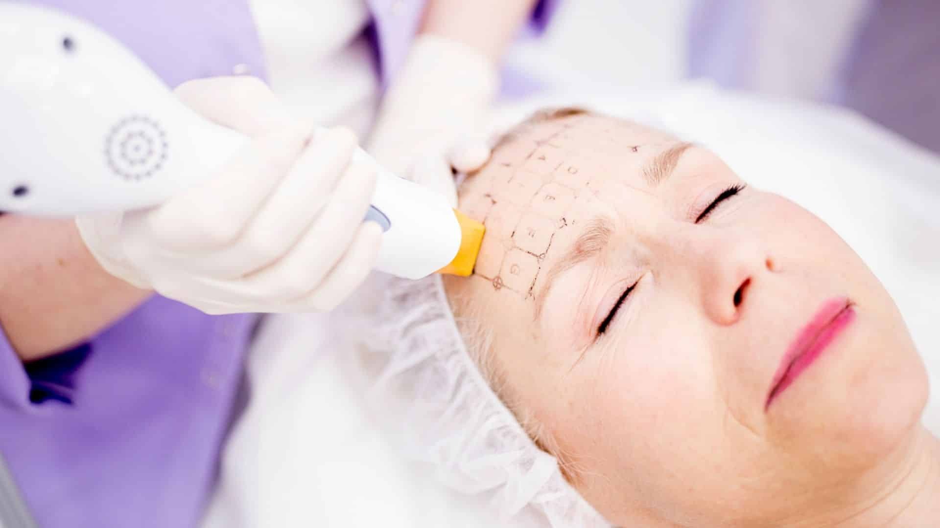 Thermage kezelés és ajakfeltöltés Debrecen